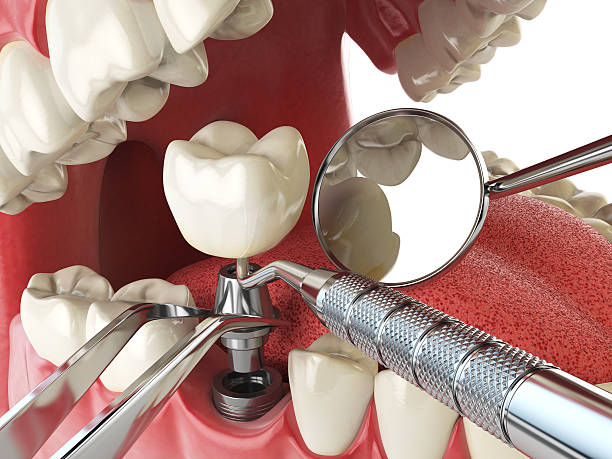Best Emergency Tooth Extraction in Highland, IN